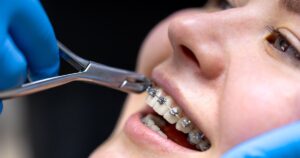 a girl with traditional braces as one of the most common orthodontic treatment options