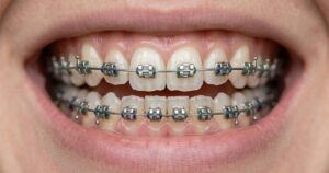 exploring alternatives to braces