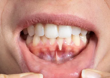 Bleeding or Swollen Gums