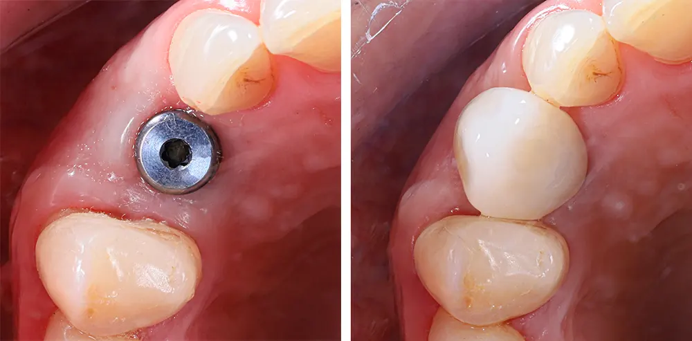 dental implant pros and cons