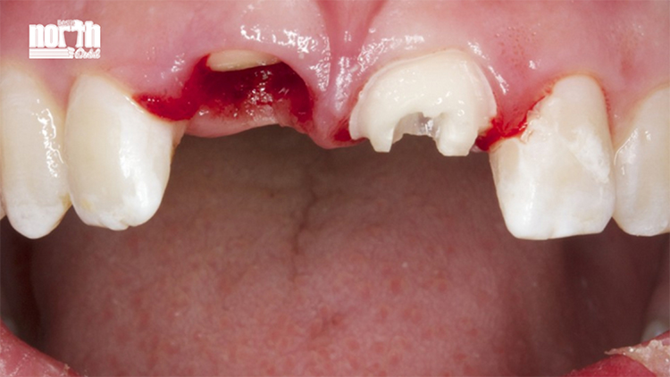 an image of a damaged crown as a result of a dental trauma
