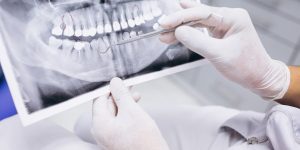 Root Canal vs. Tooth Extraction