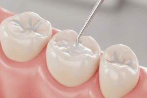Dental Filling