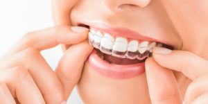 Benefits of choosing Invisalign over metal braces