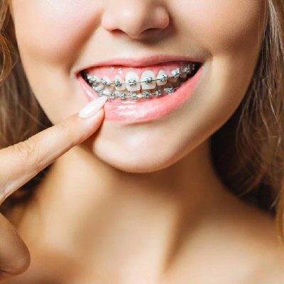 Top Advantages of Orthodontic Treatments