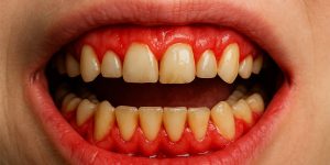 damaged-gums