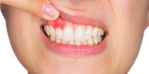 gum-abscess-symptoms An image of a dentist holding the patient's upper lip to examine the gum abscess