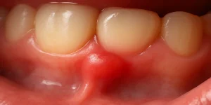 gums hurt in one spot A picture representing gums hurt in one spot