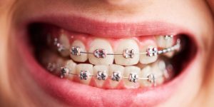 metal braces and benefits of orthodontic treatment
