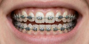 exploring alternatives to braces